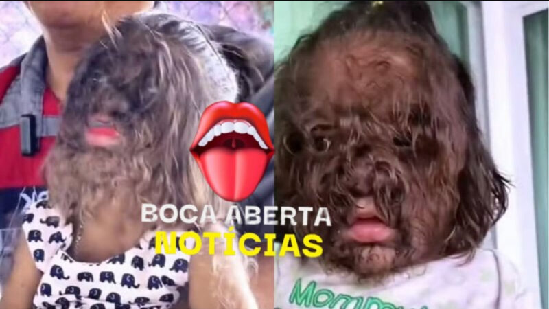 CRIANÇAS DESENVOLVEM ‘SÍNDROME DO LOBISOMEM’ APÓS PAIS USAREM LOÇÃO PARA CALVÍCIE
