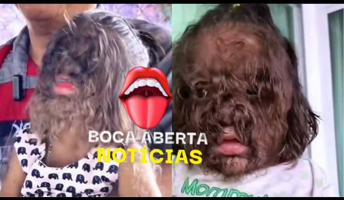 CRIANÇAS DESENVOLVEM ‘SÍNDROME DO LOBISOMEM’ APÓS PAIS USAREM LOÇÃO PARA CALVÍCIE